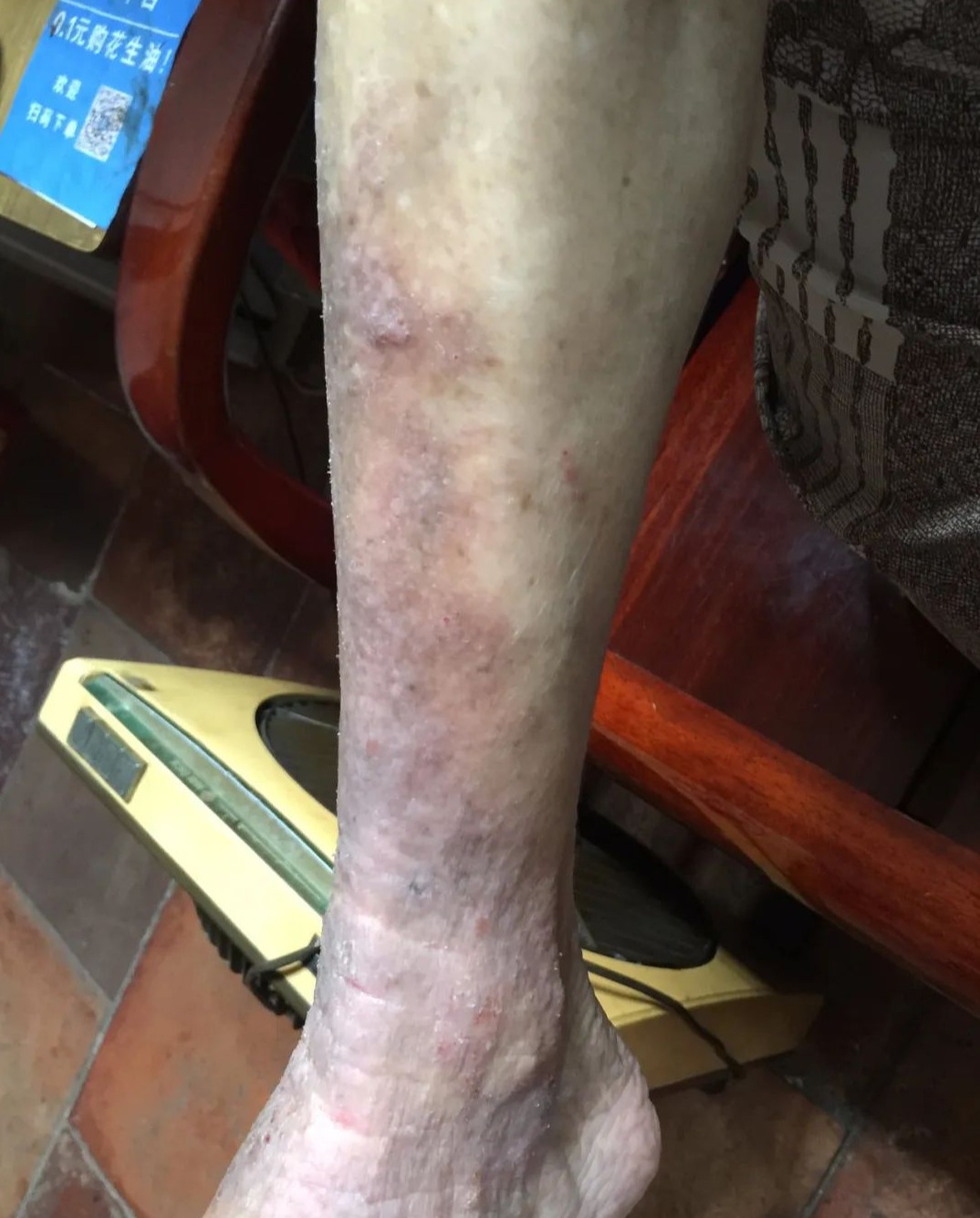 膏方治疗淤积性皮炎验案